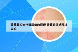 黃芪顆粒治療銀屑病的原理 黃芪銀屑病可以吃嗎