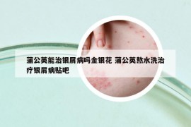 蒲公英能治銀屑病嗎金銀花 蒲公英熬水洗治療銀屑病貼吧