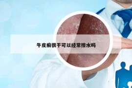 牛皮癬很干可以經常擦水嗎