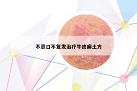 不忌口不復(fù)發(fā)治療牛皮癬土方