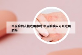 牛皮癬的人能吃山參嗎 牛皮癬病人可以吃山藥嗎