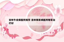 吉林牛皮癬醫(yī)院推薦 吉林銀屑病醫(yī)院哪家治療好