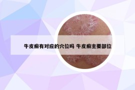 牛皮癬有對應的穴位嗎 牛皮癬主要部位