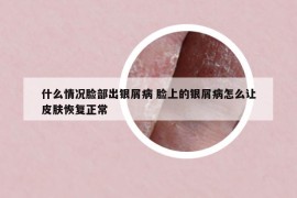 什么情況臉部出銀屑病 臉上的銀屑病怎么讓皮膚恢復(fù)正常