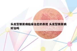 頭皮型銀屑病臨床治愈的表現(xiàn) 頭皮型銀屑病好治嗎