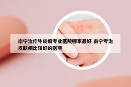南寧治療牛皮癬專業(yè)醫(yī)院哪家最好 南寧專治皮膚病比較好的醫(yī)院