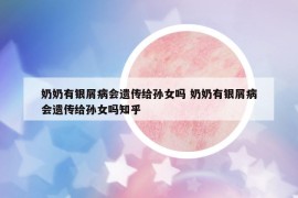 奶奶有銀屑病會(huì)遺傳給孫女嗎 奶奶有銀屑病會(huì)遺傳給孫女嗎知乎