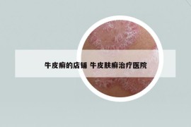 牛皮癬的店鋪 牛皮膚癬治療醫(yī)院