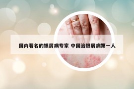 國(guó)內(nèi)著名的銀屑病專家 中國(guó)治銀屑病第一人