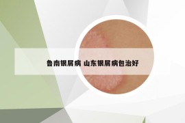 魯南銀屑病 山東銀屑病包治好