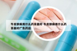 牛皮膚癬用什么藥膏最好 牛皮膚癬用什么藥膏最好廣東藥店