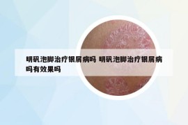 明礬泡腳治療銀屑病嗎 明礬泡腳治療銀屑病嗎有效果嗎