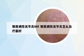 銀屑病性關(guān)節(jié)炎MR 銀屑病性關(guān)節(jié)炎怎么治療最好