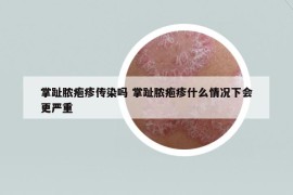 掌趾膿皰疹傳染嗎 掌趾膿皰疹什么情況下會更嚴(yán)重