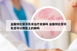 鹽酸特比萘芬乳膏治療皮癬嗎 鹽酸特比萘芬乳膏可以擦臉上的癬嗎