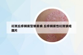 紅斑丘疹鱗屑型銀屑病 丘疹鱗屑性紅斑狼瘡圖片