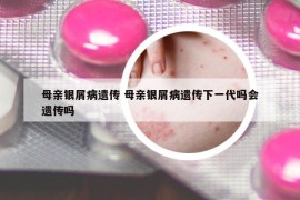 母親銀屑病遺傳 母親銀屑病遺傳下一代嗎會(huì)遺傳嗎