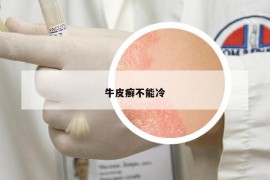 牛皮癬不能冷
