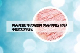 黃堯洲治療牛皮癬案例 黃堯洲中醫(yī)門診部 中醫(yī)皮膚科地址