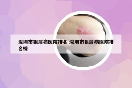 深圳市銀屑病醫(yī)院排名 深圳市銀屑病醫(yī)院排名榜