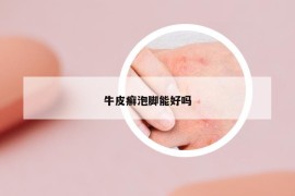 牛皮癬泡腳能好嗎