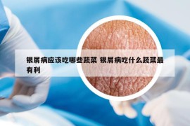 銀屑病應該吃哪些蔬菜 銀屑病吃什么蔬菜最有利