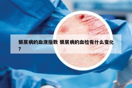 銀屑病的血液指數(shù) 銀屑病的血檢有什么變化?