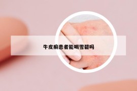 牛皮癬患者能喝雪碧嗎