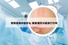 類銀屑病吊瓶好么 銀屑病可以輸液打針嗎