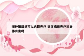 哪種銀屑病可以選擇光療 銀屑病用光療對(duì)身體有害嗎