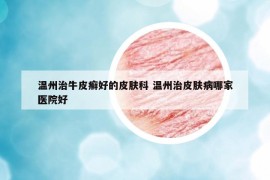 溫州治牛皮癬好的皮膚科 溫州治皮膚病哪家醫(yī)院好