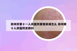 鄭州市第十一人民醫(yī)院看銀屑病怎么 鄭州第十人民醫(yī)院皮膚科