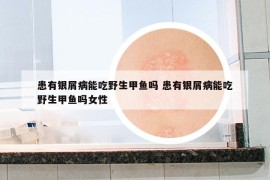 患有銀屑病能吃野生甲魚嗎 患有銀屑病能吃野生甲魚嗎女性