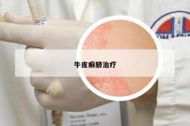 牛皮癬臍治療
