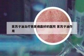紫蘇子油治療銀屑病最好的醫(yī)院 紫蘇子油作用
