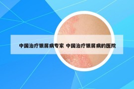 中國治療銀屑病專家 中國治療銀屑病的醫(yī)院