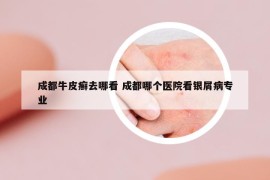 成都牛皮癬去哪看 成都哪個醫(yī)院看銀屑病專業(yè)