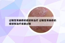過敏性蕁麻疹的癥狀和治療 過敏性蕁麻疹的癥狀和治療皮膚過敏