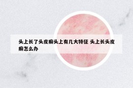 頭上長了頭皮癬頭上有幾大特征 頭上長頭皮癬怎么辦