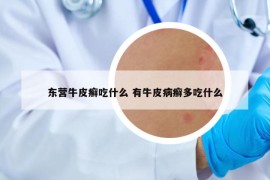東營牛皮癬吃什么 有牛皮病癬多吃什么