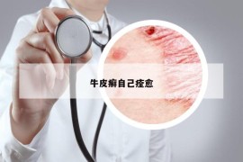 牛皮癬自己痊愈