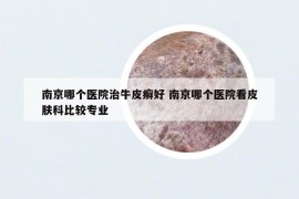 南京哪個醫(yī)院治牛皮癬好 南京哪個醫(yī)院看皮膚科比較專業(yè)