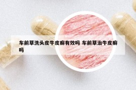 車前草洗頭皮牛皮癬有效嗎 車前草治牛皮癬嗎