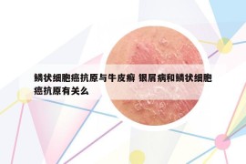 鱗狀細(xì)胞癌抗原與牛皮癬 銀屑病和鱗狀細(xì)胞癌抗原有關(guān)么