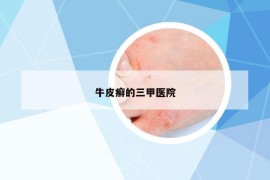 牛皮癬的三甲醫(yī)院