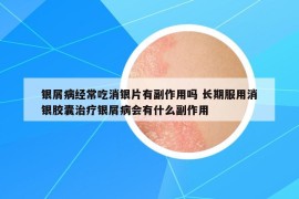 銀屑病經(jīng)常吃消銀片有副作用嗎 長(zhǎng)期服用消銀膠囊治療銀屑病會(huì)有什么副作用
