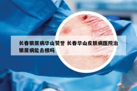長春銀屑病華山贊譽(yù) 長春華山皮膚病醫(yī)院治銀屑病能去根嗎