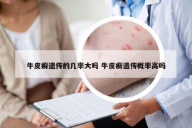 牛皮癬遺傳的幾率大嗎 牛皮癬遺傳概率高嗎