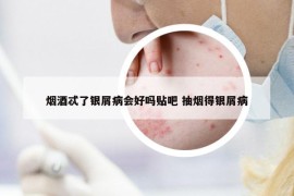 煙酒忒了銀屑病會(huì)好嗎貼吧 抽煙得銀屑病