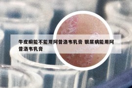 牛皮癬能不能用阿昔洛韋乳膏 銀屑病能用阿昔洛韋乳膏